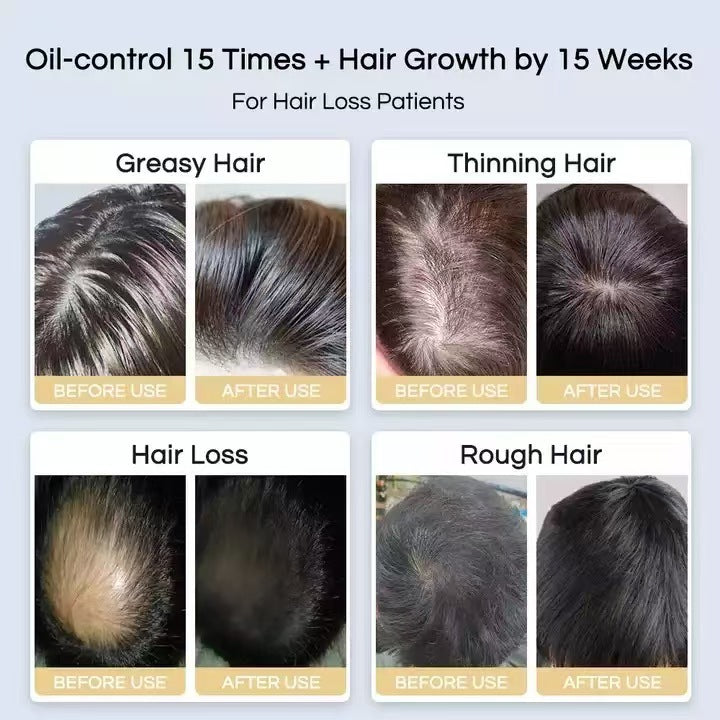 Laser Hair Growth Helmet with Red Light Therapy