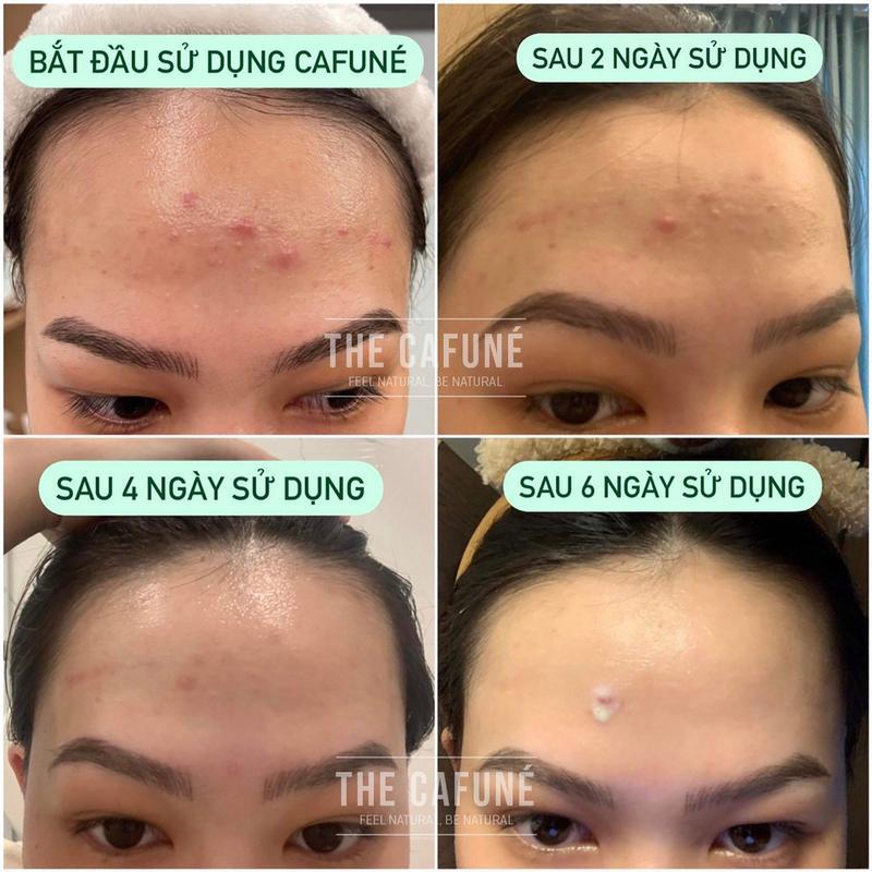 Acne Cream & Soothing Gel for Oily and Dry Skin